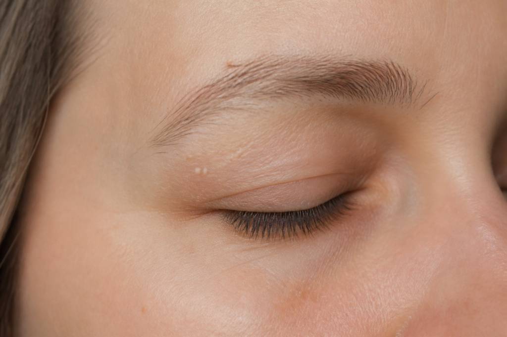 Boutons blancs paupières : causes, traitements et conseils efficaces Boutons blancs paupières : causes, traitements et conseils efficaces