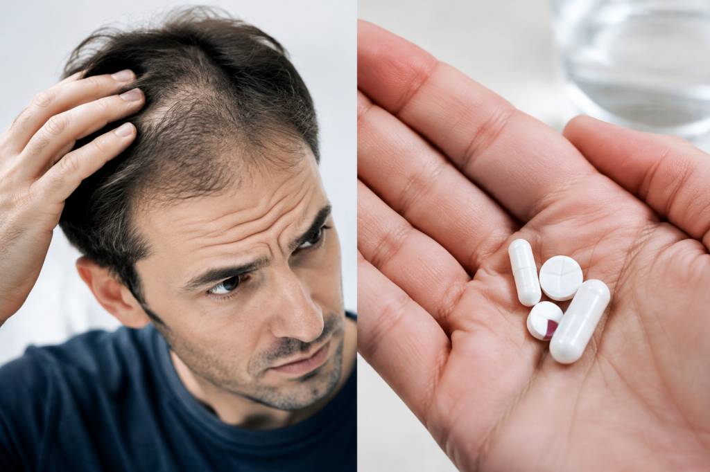 Finastéride et minoxidil : quelles différences contre la chute de cheveux ? Finastéride et minoxidil : quelles différences contre la chute de cheveux ?
